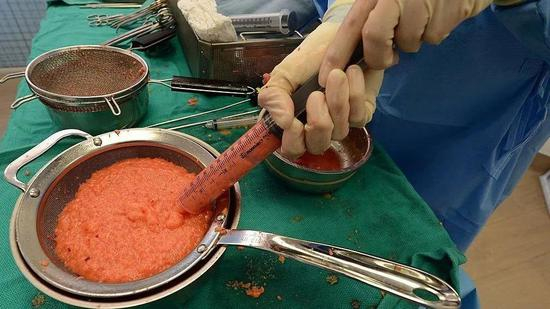 　被抽出体外的脂肪组织