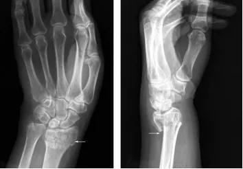 图1&nbsp;手部X线片（白色部位为骨骼，边缘白色模糊部分为软组织）图片来源：X线读片指南——王书轩、范国光主编