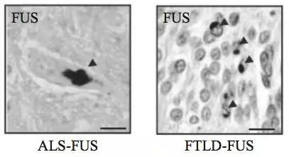 FUS 蛋白在渐冻症和额颞痴呆。患者脑中的异常聚集 （箭头所指）&nbsp;[2]