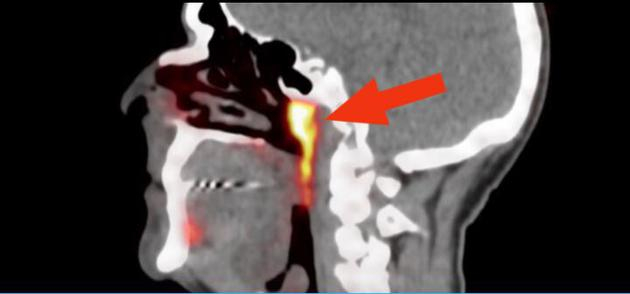 在鼻腔和喉咙交汇的角落里，可能隐藏着一对此前从未发现的唾液腺