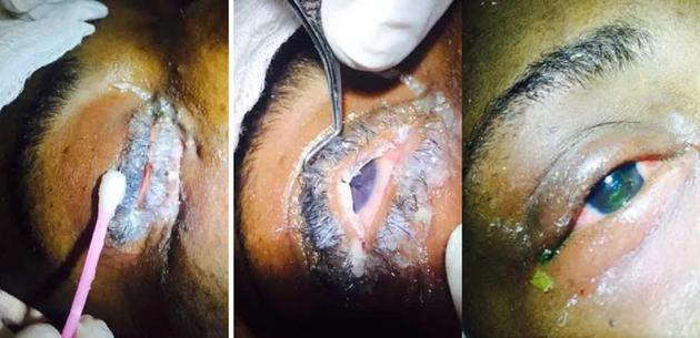 因黑暗中误将强力胶当成药膏的案例