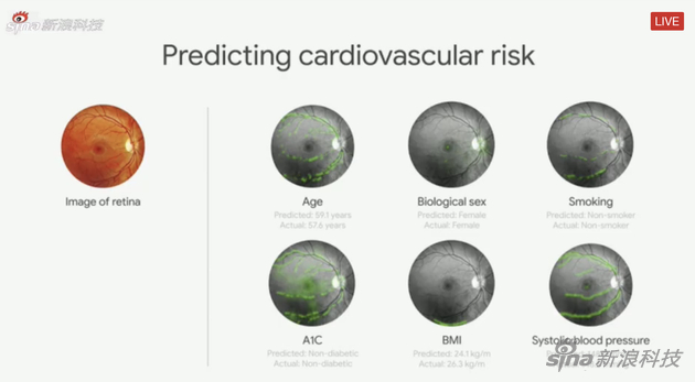 AI帮助判断眼部病情