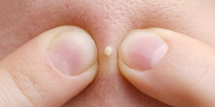 被恶心的东西吸引?爱看挤痘痘视频背后的科学