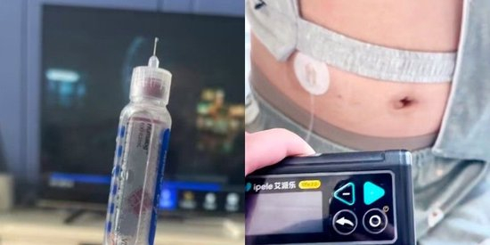 姨导泵什么价格国产胰岛素泵崛起:艾派乐精智泵实现控糖自由,患者实测糖化血红蛋白显著下降-上海聚慕医疗器械有限公司