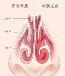 儿童鼻窦炎科普