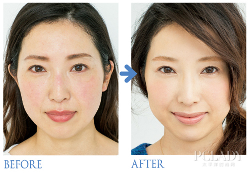 前后对比之下就能看到原本发红的地方已经减弱至正常肤色