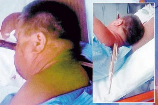 波兰男子遭38厘米长的木棍穿头，自行到医院求救。