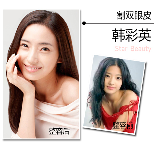 韩彩英整容