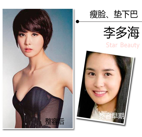除了整鼻子和眼睛外，还做过了一项整容手术，那就是瘦脸