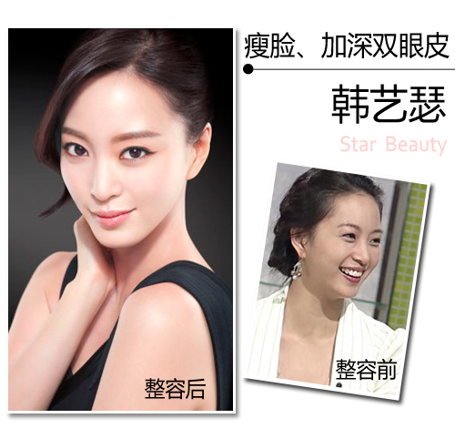 瘦脸、加深双眼皮