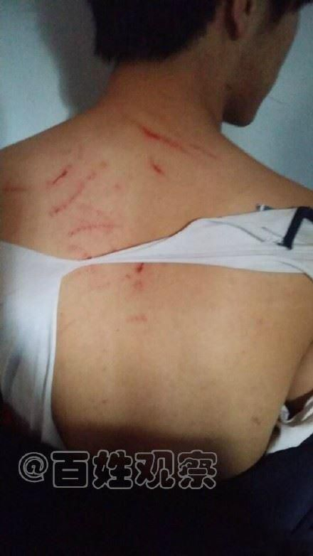 男生背部满是抓痕