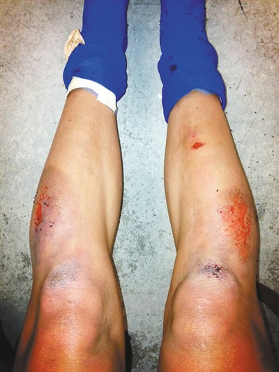 美国前锋勒鲁曾在社交网络上晒出她在人工草皮上遭严重擦伤的图片