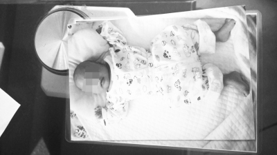 术前小名诊断为麦克尔憩室、肠梗阻伴粘连、支气管肺炎。