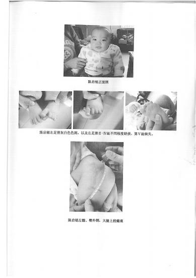 治疗遗留：小名左髂、臀外侧、大腿上段瘢痕形成；左足第二、三、四趾不同程度缺损，第五趾缺失。