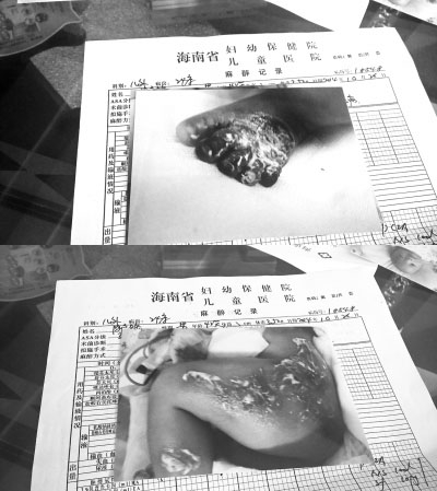 　　术后小名全身硬肿明显，臀部左下肢大片红肿，见大小不等水疱，左足第2-5趾有青紫，以小趾明显，严重，为完全青紫等情况，诊断为“II度烫伤，右足趾挤压伤”。