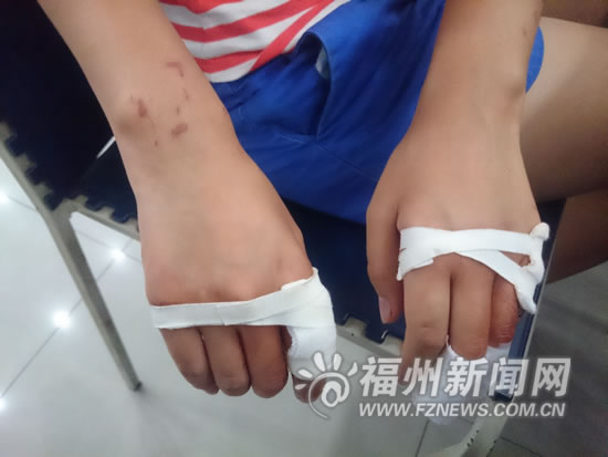 小玉的手指被裁纸刀划破后缝了十针，手腕上还有密集的指甲印。