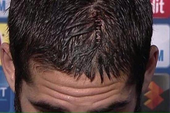 皇马大将头缝9针 满脸是血 四换球衣(图)