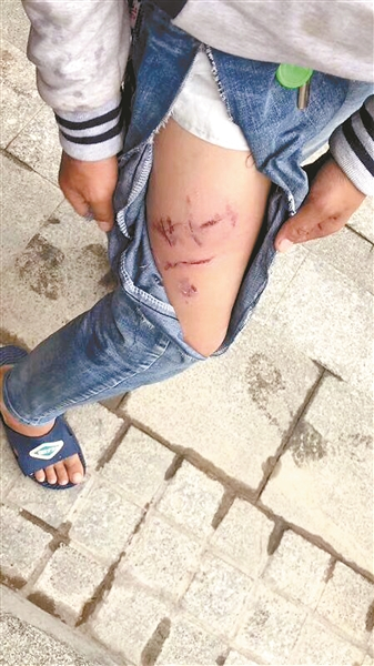 一名男孩大腿被狗咬伤，牛仔裤被咬坏。南国早报 图