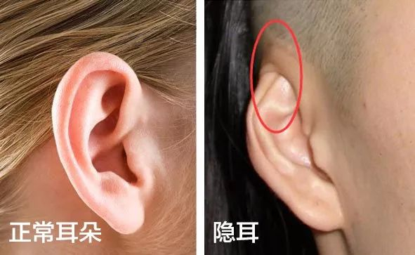 隐耳
