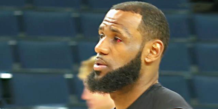 詹姆斯被格林戳中的眼睛充血严重,帕金斯看了