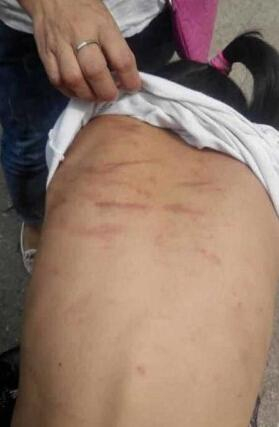 因为家庭小事，多次被亲妈拳打脚踢甚至用竹棍猛抽，致使全身伤痕累累