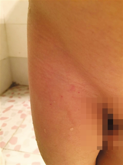 林林（化名）大腿根部出现红色斑点，疑似针眼。家属供图