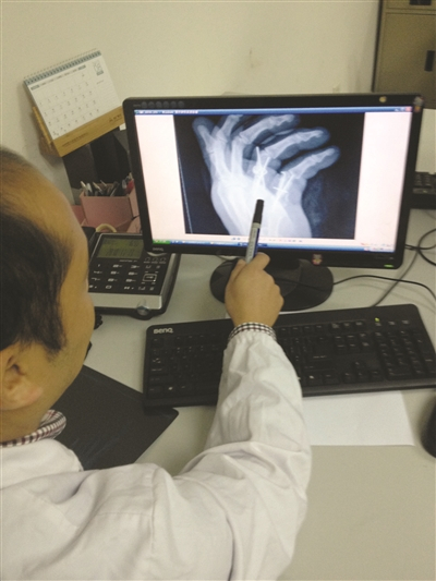 X光片上能看到手术留下的钢钉。