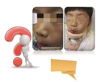 互殴后受伤的孩子。图片来自网络