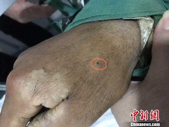 赵兴军（化名）右手背上的伤口。　梁辉 摄