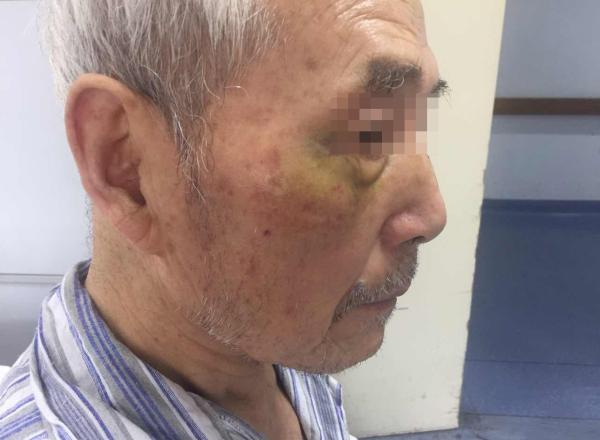 老人左手手臂骨折，右眼角等明显淤青。 澎湃新闻记者 陈斯斯 图