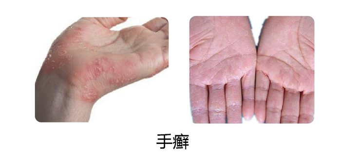 手上痒痒的小水泡,很可能是这俩病!