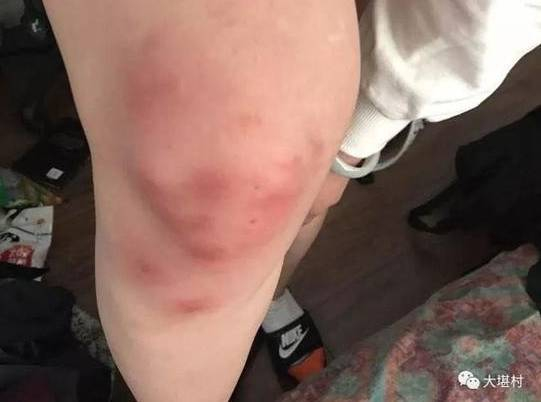 被打留学生讲述，还有一名女留学生被踢膝盖、掐脖子（图片来自微信公众号“大堪村”）