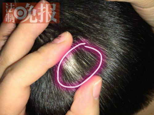 　　2015年12月8日上午，有吉林省四平市的市民拨打法晚新闻热线称，四平市红黄蓝幼儿园约30名幼儿遭老师针扎虐童。孩子头上出现的针状扎孔。