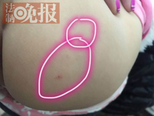 孩子身上出现的针状扎孔。