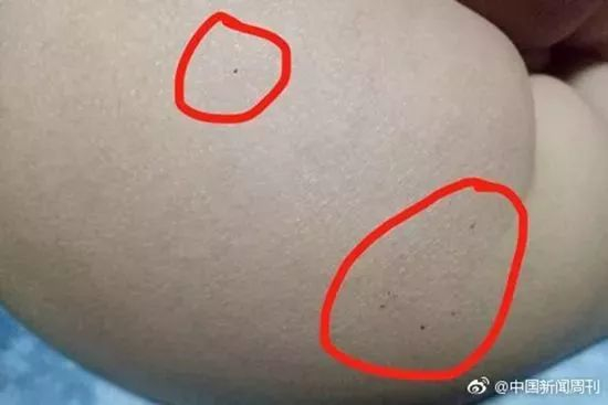 据多名红黄蓝（新天地分园）家长反映，孩子腿部、屁股、腋下出现针眼