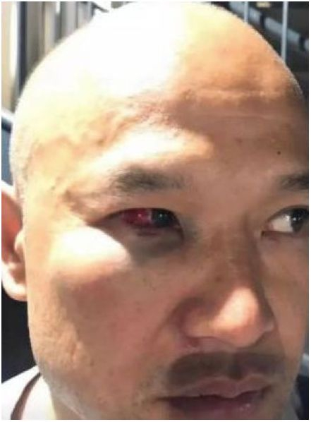 资料图：光头警长刘sir7月30日晚遭暴徒围殴后，眼角出血。