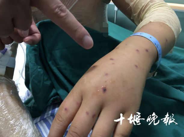 黄妈妈胳膊上被蜇的伤口
