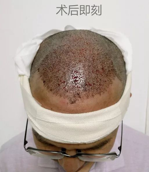 术后