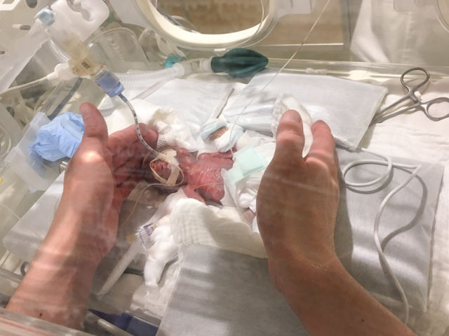 ↑男婴刚出生5天时的资料照片。