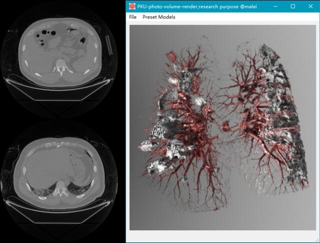 　　左侧是传统的胸部CT图像，右侧是北大高真实感体渲染技术对CT图像集的高真实感可视化 图片来自北大新闻网