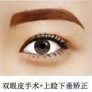 上睑下垂