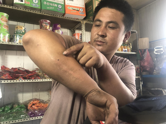 范廷才二弟范廷有向记者展示其被打的伤疤。新京报记者 卢通 摄