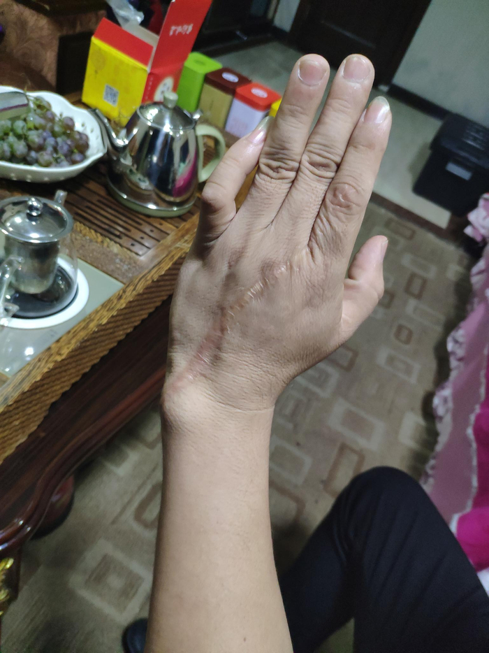 王永宏向记者展示其手上的伤疤，其小拇指至今无法伸直。新京报记者 卢通 摄