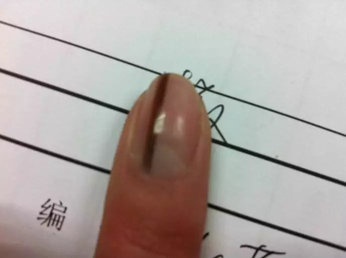 指甲上长了条黑线，到医院一查吓坏了，有可能癌变！