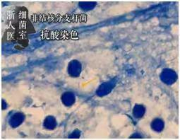  非结核分枝杆菌原始脓液标本抗酸染色