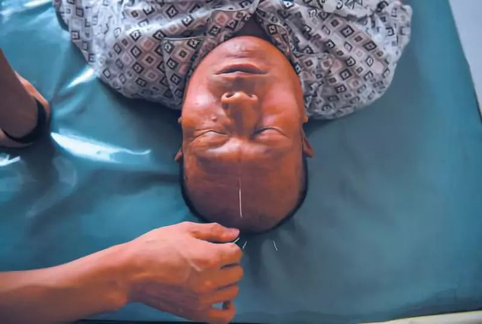 ▲8月17日，河北沧州市盐山县，64岁的刘海兴在医院做针灸理疗。