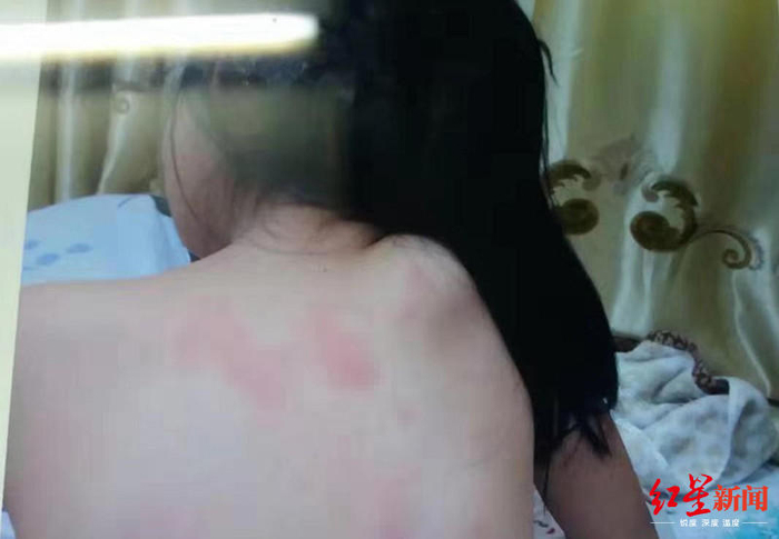  ↑被殴打后，高欣后背出现多处红肿