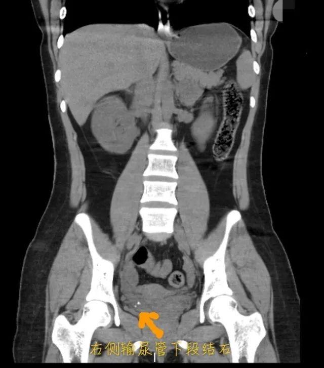 腹中剧痛3天，17岁姑娘忍着坚持学习！拍了CT，父母瞬间傻眼