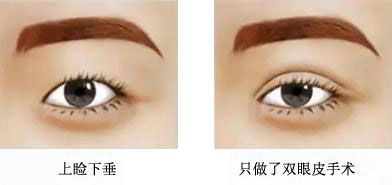 上睑下垂
