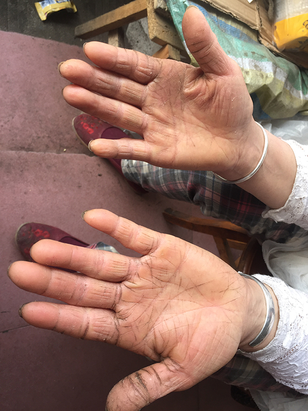 49岁张晓晶的手掌开裂，自嘲手一看就是做苦力的。